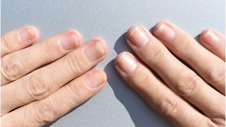 Onicoliza: tot ce trebuie să știi despre această afecțiune a unghiilor